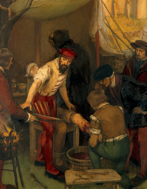 Ambroise Paré réalisant une amputation